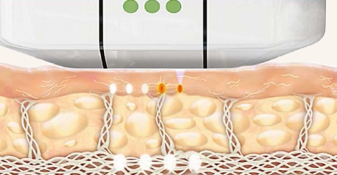 seoul anti-aging, lifting laser